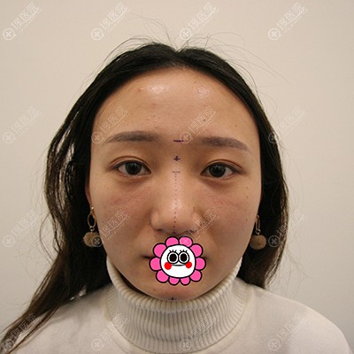 到郑州辰星找王保健做了耳软骨隆鼻和硅胶隆下巴来弥补我的短板
