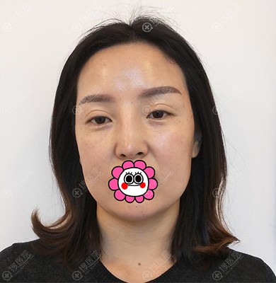 在张家口维多利亚找李启飞体验面部吸脂后孩子都说妈妈变漂亮了