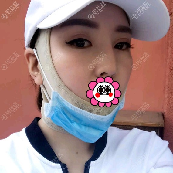 面部吸脂术后需要带头套固定 面部吸脂术后需要带头套固定