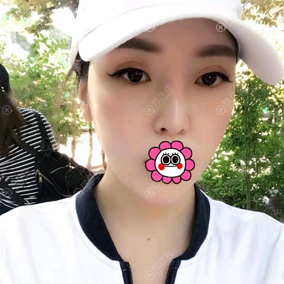 面部吸脂术后8天露出小V脸 面部吸脂术后8天露出小V脸