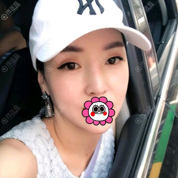 面部吸脂术后半个月效果明显 面部吸脂术后半个月效果明显