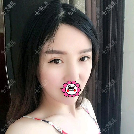 张家口维多利亚李启飞做面部吸脂术后恢复一个月效果 张家口维多利亚李启飞做面部吸脂术后恢复一个月效果