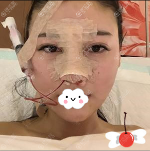 济南艺星肋软骨鼻综合术后即刻 济南艺星肋软骨鼻综合术后即刻