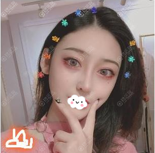 济南艺星杨季涛肋软骨隆鼻效果 济南艺星杨季涛肋软骨隆鼻效果