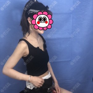 我找天津联合丽格王文凯做280cc假体隆胸才有资本把腰背挺起来