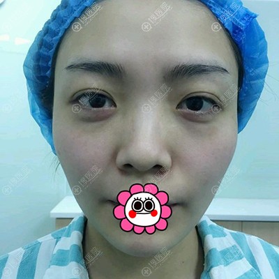 感谢重庆徐铎丽格为我做的耳软骨隆鼻 恢复后的效果像天赐一样