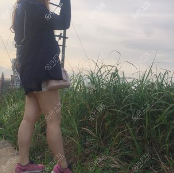 自从找重庆时光孔令杰做了大腿吸脂我再也不用把腿藏起来了