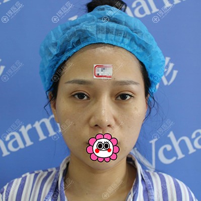 都说郑州医德佳隆鼻失败修复做的不错 我就去做了肋软骨隆鼻
