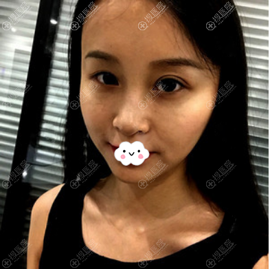 之前双眼皮失败眼睛不对称一大一小 之前双眼皮失败眼睛不对称一大一小