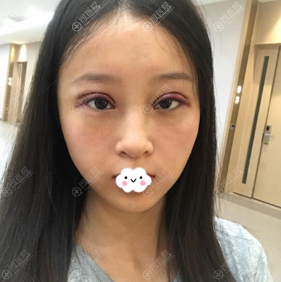 <!--<i data=20240710 data-id=12057></i>-->林靖双眼皮术后即刻 <!--<i data=20240710 data-id=12057></i>-->林靖双眼皮术后即刻
