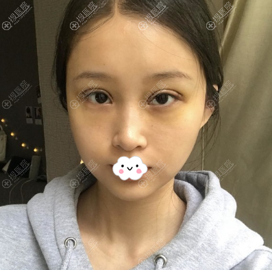 林靖眼部修复术后6天恢复照片 林靖眼部修复术后6天恢复照片