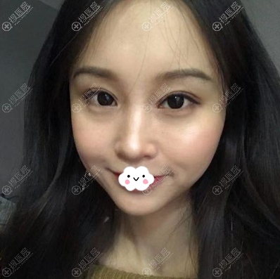 <!--<i data=20240710 data-id=12057></i>-->林靖双眼皮修复术后效果图 <!--<i data=20240710 data-id=12057></i>-->林靖双眼皮修复术后效果图