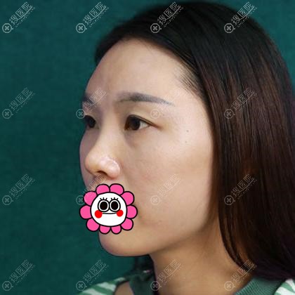 南京美莱给我做的膨体隆鼻恢复三个月后效果自然可揉捏