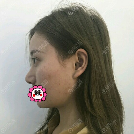 到潍坊华美做鼻整形修复时没报多大希望没想到术后效果令我满意