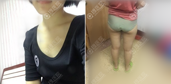 我是打听了郑州张朝蕾做自体脂肪丰胸的口碑后才来做的手术