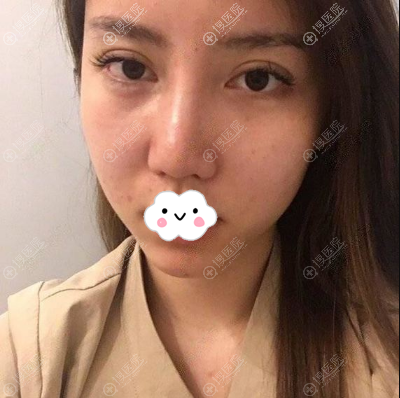 找昆明美伊莱周诚做面部吸脂手术就是想让左右脸对称脸在瘦点