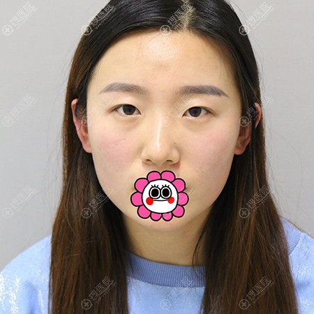 ���Ͳ���������˫��Ƥǰ