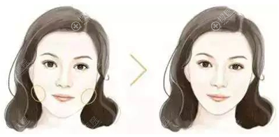 除了想知道脸部磨腮削骨的后遗症,我们还关注他的恢复期和价格