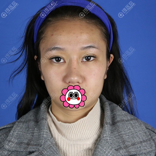 面部轮廓显老到昆明艺星找白春燕做了面部埋线提升恢复年轻紧致