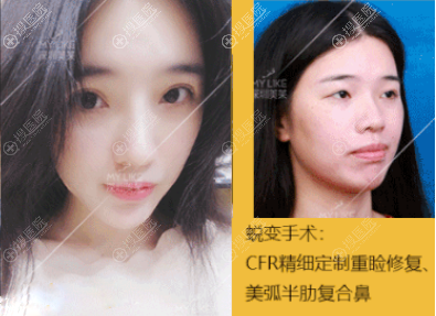 深圳美莱梁志为双眼皮隆鼻案例 深圳美莱梁志为双眼皮隆鼻案例