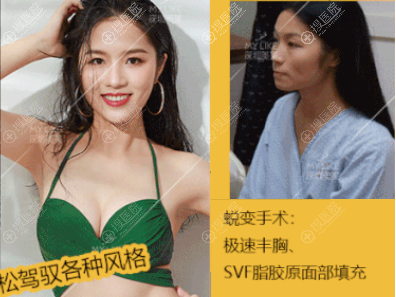 深圳美莱郭杰全面部脂肪填充+假体丰胸案例 深圳美莱郭杰全面部脂肪填充+假体丰胸案例