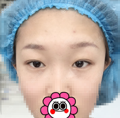在汕头华美整形医院做双眼皮隆鼻手术的时候是我妈陪我一起去的