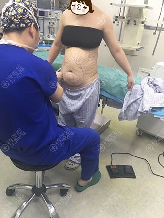 西安高一生张林宏做的腰腹吸脂手术案例一个月达到满意的效果