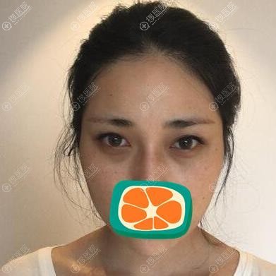 兰州崔大夫做双眼皮前 兰州崔大夫做双眼皮前