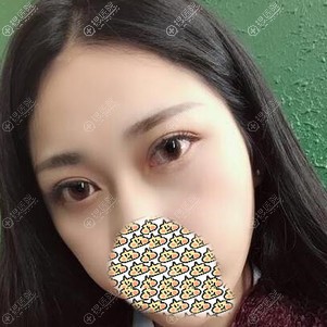 兰州崔大夫师芸红做双眼皮术后恢复40天效果 兰州崔大夫师芸红做双眼皮术后恢复40天效果