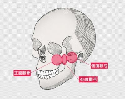 非常担心做完颧骨内推或降低会导致面部下垂怎么办?