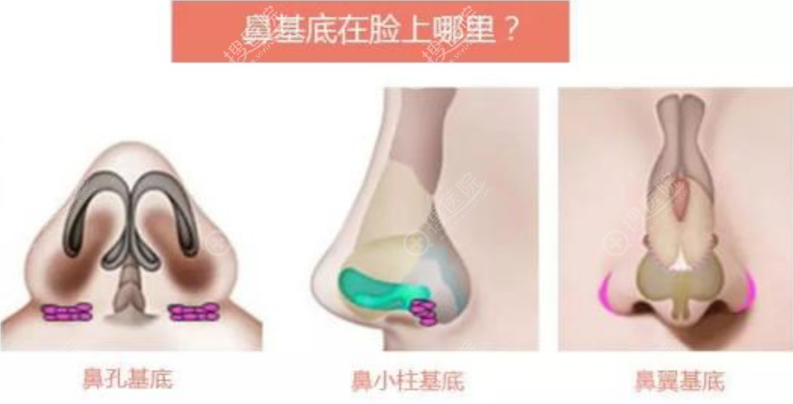今日讲解鼻基底填充作用及垫鼻基底能解决凸嘴吗?