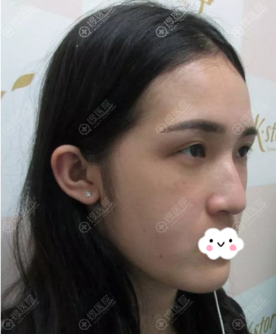 韩国碧夏整形李珉仕给我做的全脸脂肪填充效果朋友们羡慕的不行