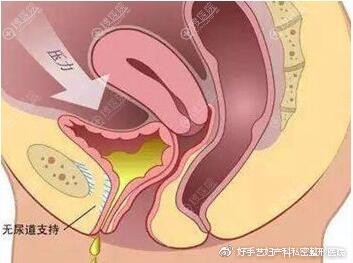 韩国好手艺后方膣圆盖手术 韩国好手艺后方膣圆盖手术