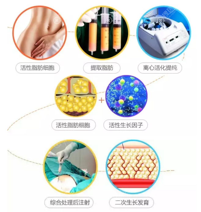 自体脂肪移植填充术前必须了解的5大问题与6大优势!
