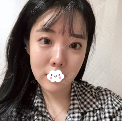 韩国留学生谈找玛博尔徐逸范做隆鼻垫下巴手术的原因及术后效果