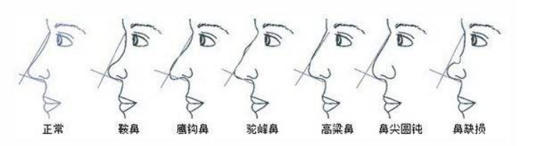 北京做鞍鼻整形的价格是多少钱,帮你了解鞍鼻有救吗该如何美化