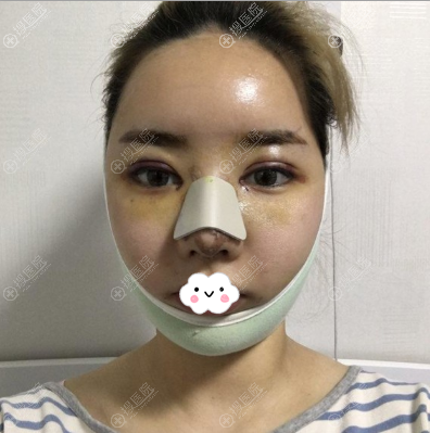韩国爱我朴范镇面部轮廓修复眼鼻修复术后 韩国爱我朴范镇面部轮廓修复眼鼻修复术后