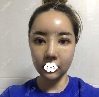 面部轮廓修复拆线后效果图 面部轮廓修复拆线后效果图