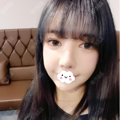 面部轮廓修复手术400天恢复照片 面部轮廓修复手术400天恢复照片