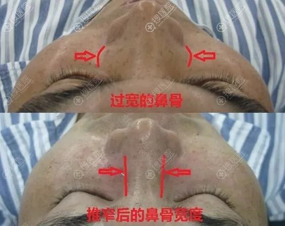 今天为大家讲讲鼻骨内推的优缺点及价格看看鼻骨内推有必要做吗