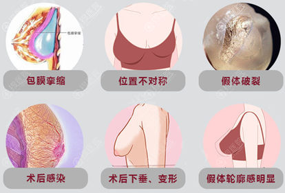 假体隆胸取出会干瘪吗?为什么明星做完隆胸又把假体取出?