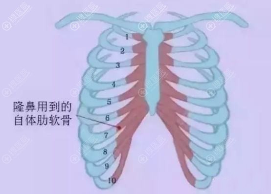 为什么有的人说千万不要自体肋骨隆鼻?解读肋骨隆鼻后遗症