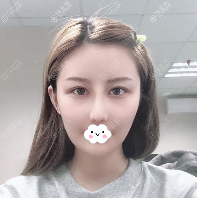 聊聊韩国女神权升基给我做V-line瓜子脸磨骨加下巴整形效果咋样