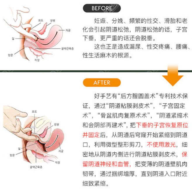 韩国好手艺后方膣圆盖术前后改善对比 韩国好手艺后方膣圆盖术前后改善对比