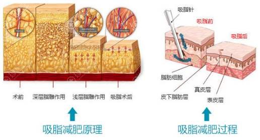 韩国365mc像打针一样简单方便的兰斯lams吸脂是不是噱头?
