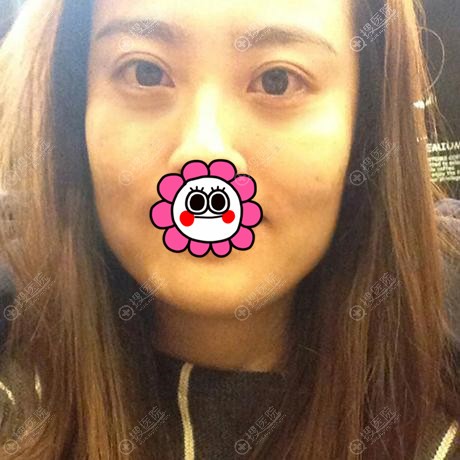 国字脸女生丑找韩国菲斯莱茵李真秀做轮廓四件套后变自然小清新