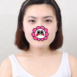 到韩国原辰做面部轮廓前照片 到韩国原辰做面部轮廓前照片