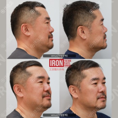 韩国艾恩院长金承俊亲测双下巴吸脂+激光面部提升和赘肉说拜拜