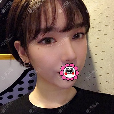 韩国艾恩人气三件套术后恢复一个月案例 韩国艾恩人气三件套术后恢复一个月案例