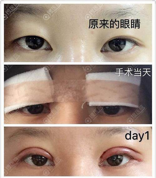 不知道割双眼皮20天是什么样子的来看恢复过程图